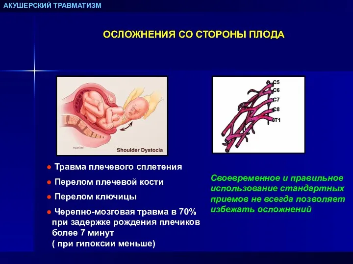 АКУШЕРСКИЙ ТРАВМАТИЗМ ОСЛОЖНЕНИЯ СО СТОРОНЫ ПЛОДА Травма плечевого сплетения Перелом