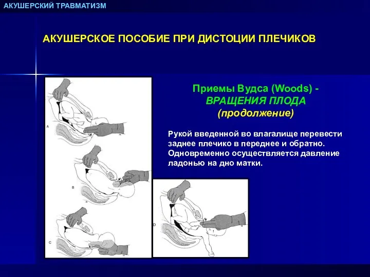 АКУШЕРСКИЙ ТРАВМАТИЗМ АКУШЕРСКОЕ ПОСОБИЕ ПРИ ДИСТОЦИИ ПЛЕЧИКОВ Приемы Вудса (Woods)