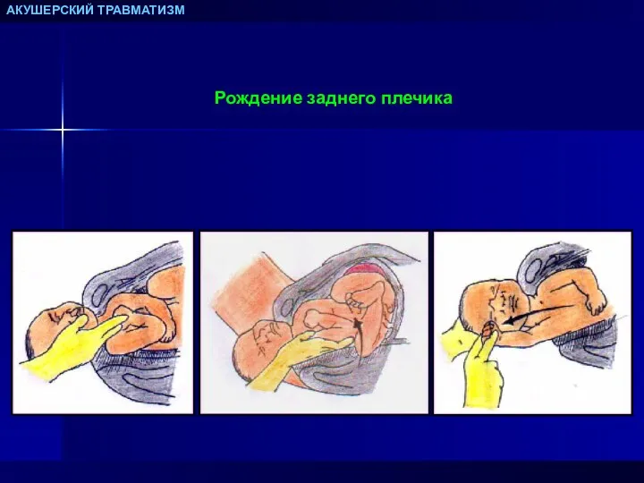 АКУШЕРСКИЙ ТРАВМАТИЗМ Рождение заднего плечика