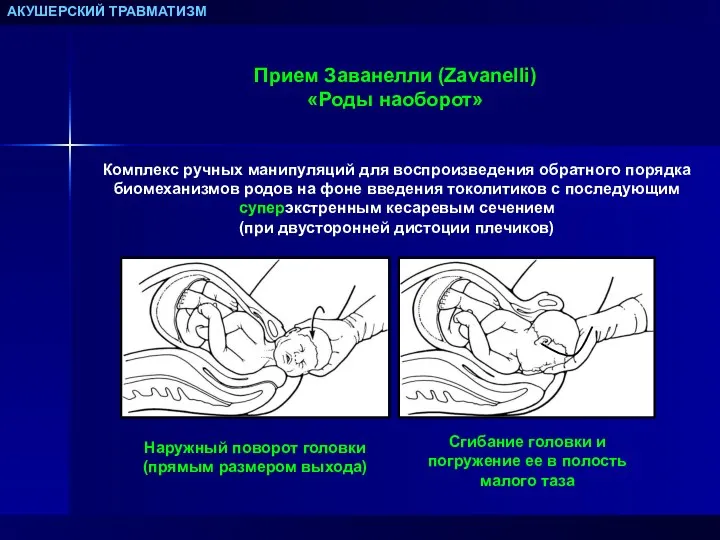 АКУШЕРСКИЙ ТРАВМАТИЗМ Прием Заванелли (Zavanelli) «Роды наоборот» Комплекс ручных манипуляций