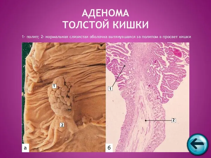 1- полип; 2- нормальная слизистая оболочка вытянувшаяся за полипом в