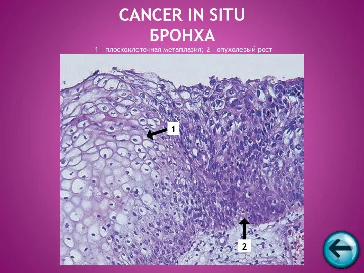 1 – плоскоклеточная метаплазия; 2 – опухолевый рост CANCER IN SITU БРОНХА 1 2