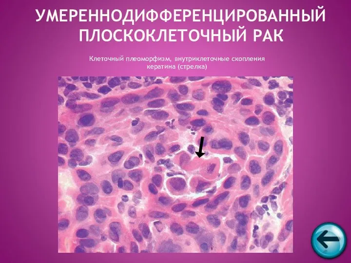 Клеточный плеоморфизм, внутриклеточные скопления кератина (стрелка) УМЕРЕННОДИФФЕРЕНЦИРОВАННЫЙ ПЛОСКОКЛЕТОЧНЫЙ РАК