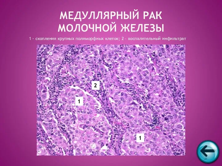 1 - скопления крупных полиморфных клеток; 2 – воспалительный инфильтрат