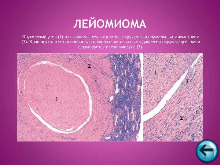 Опухолевый узел (1) из гладкомышечных клеток, окруженный нормальным миометрием (2).