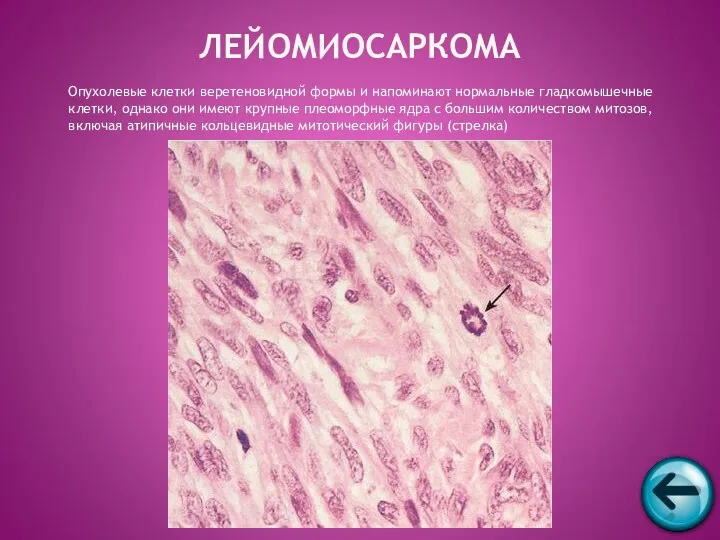 Опухолевые клетки веретеновидной формы и напоминают нормальные гладкомышечные клетки, однако