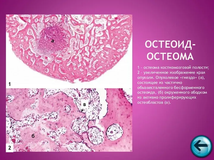 1 – остеома костномозговой полости; 2 – увеличенное изображение края