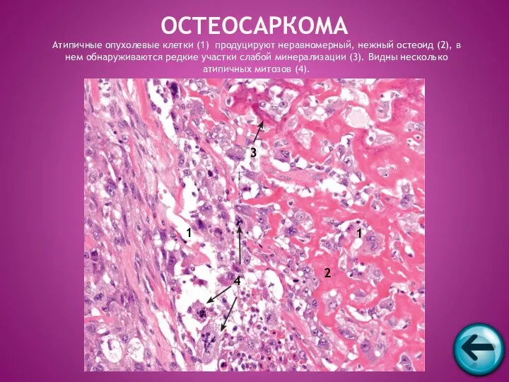Атипичные опухолевые клетки (1) продуцируют неравномерный, нежный остеоид (2), в