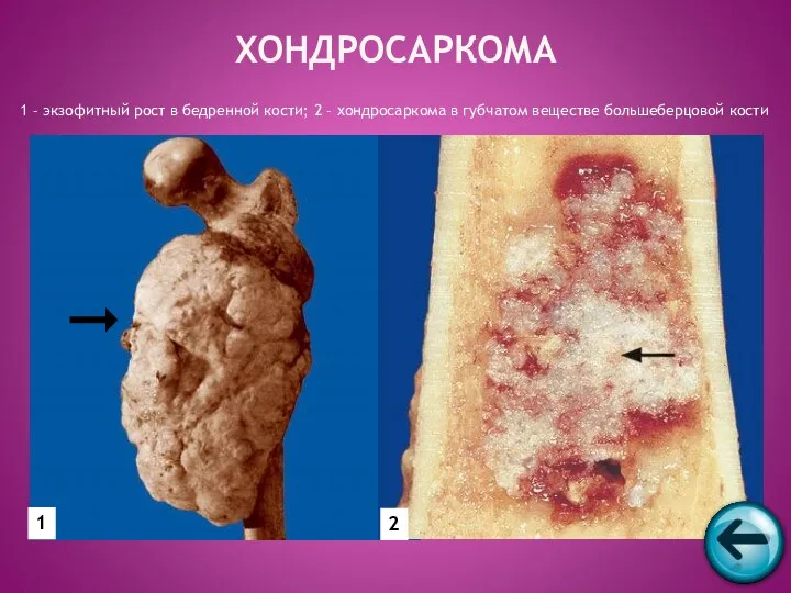 ХОНДРОСАРКОМА 1 – экзофитный рост в бедренной кости; 2 –