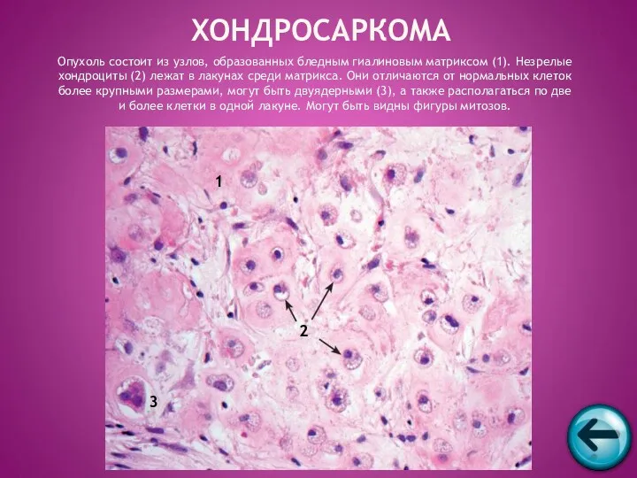 Опухоль состоит из узлов, образованных бледным гиалиновым матриксом (1). Незрелые