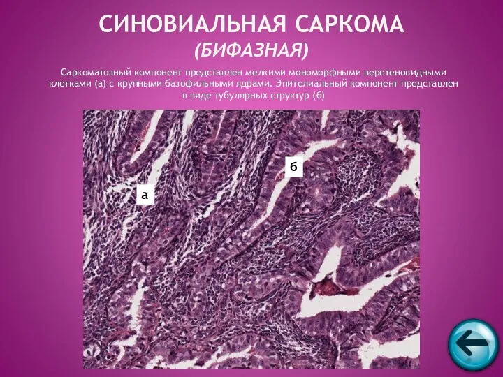 Саркоматозный компонент представлен мелкими мономорфными веретеновидными клетками (а) с крупными