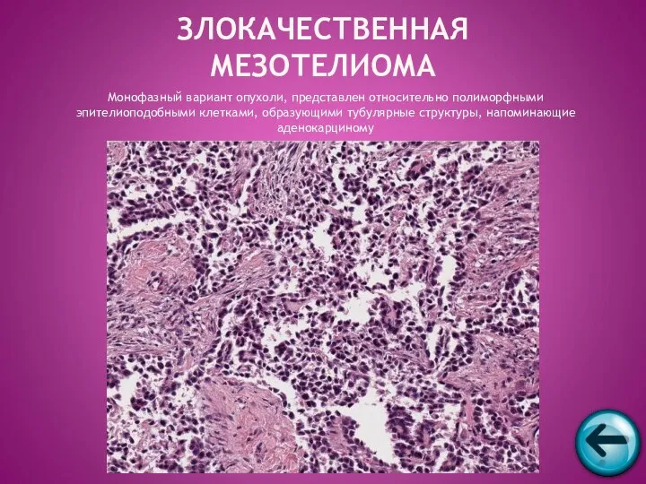 Монофазный вариант опухоли, представлен относительно полиморфными эпителиоподобными клетками, образующими тубулярные структуры, напоминающие аденокарциному ЗЛОКАЧЕСТВЕННАЯ МЕЗОТЕЛИОМА