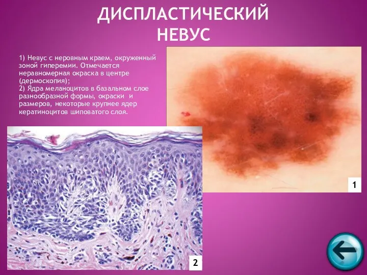 1) Невус с неровным краем, окруженный зоной гиперемии. Отмечается неравномерная