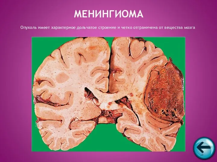 Опухоль имеет характерное дольчатое строение и четко отграничена от вещества мозга МЕНИНГИОМА
