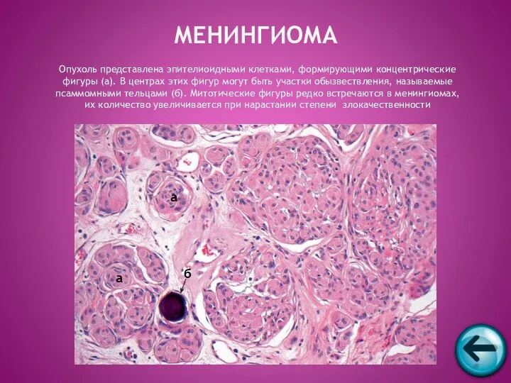 Опухоль представлена эпителиоидными клетками, формирующими концентрические фигуры (а). В центрах