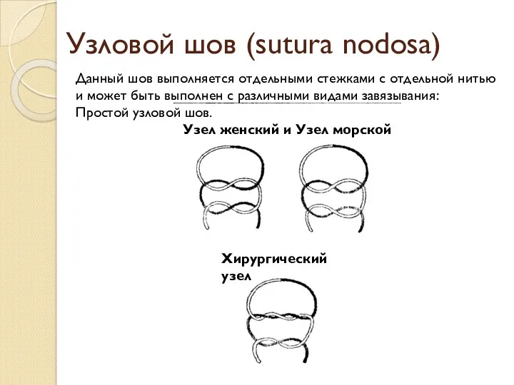 Узловой шов (sutura nodosa) Данный шов выполняется отдельными стежками с отдельной нитью и