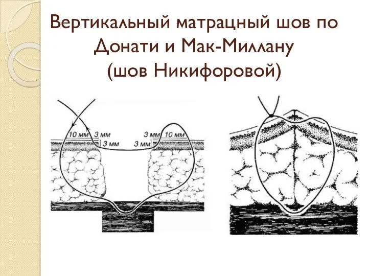 Вертикальный матрацный шов по Донати и Мак-Миллану (шов Никифоровой)