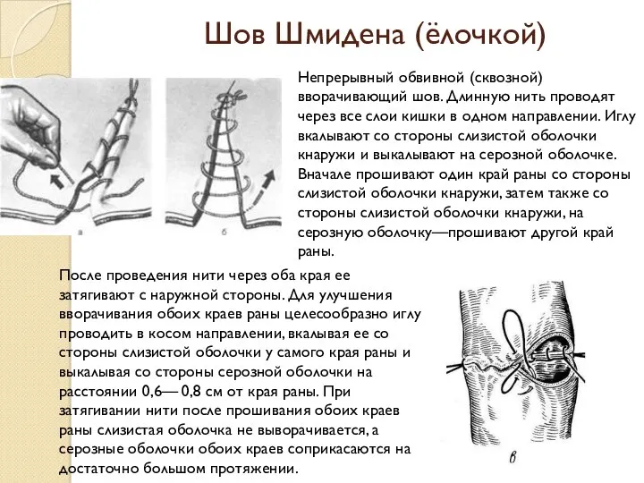 Шов Шмидена (ёлочкой) После проведения нити через оба края ее затягивают с наружной