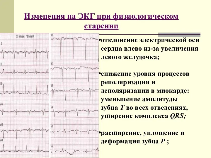 Изменения на ЭКГ при физиологическом старении отклонение электрической оси сердца