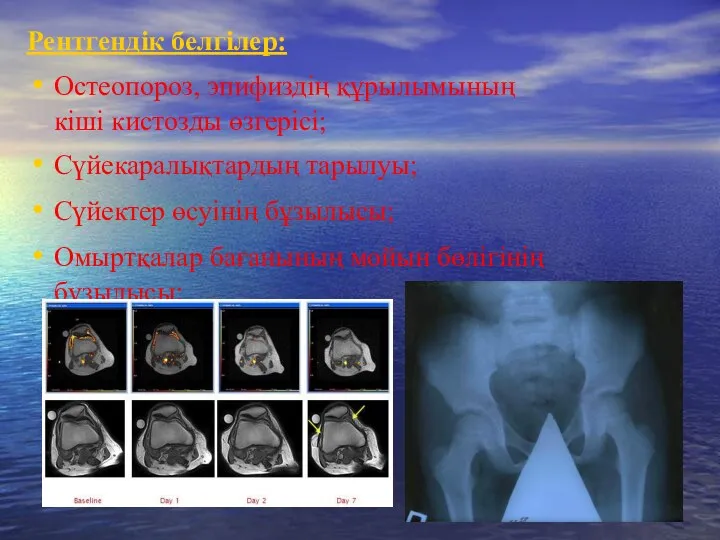 Рентгендік белгілер: Остеопороз, эпифиздің құрылымының кіші кистозды өзгерісі; Сүйекаралықтардың тарылуы;