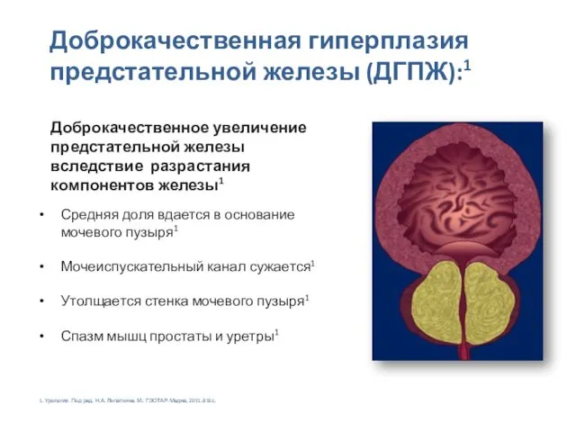 Средняя доля вдается в основание мочевого пузыря1 Мочеиспускательный канал сужается1