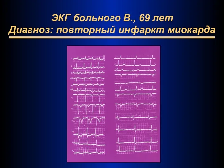 ЭКГ больного В., 69 лет Диагноз: повторный инфаркт миокарда