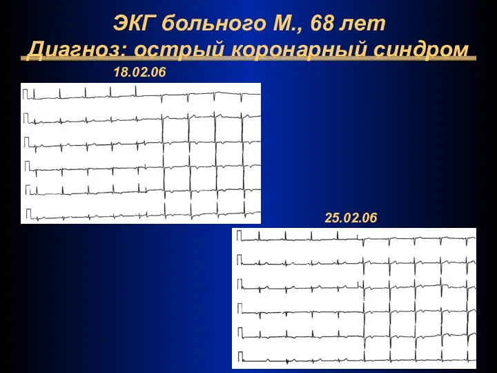 ЭКГ больного М., 68 лет Диагноз: острый коронарный синдром 18.02.06 25.02.06