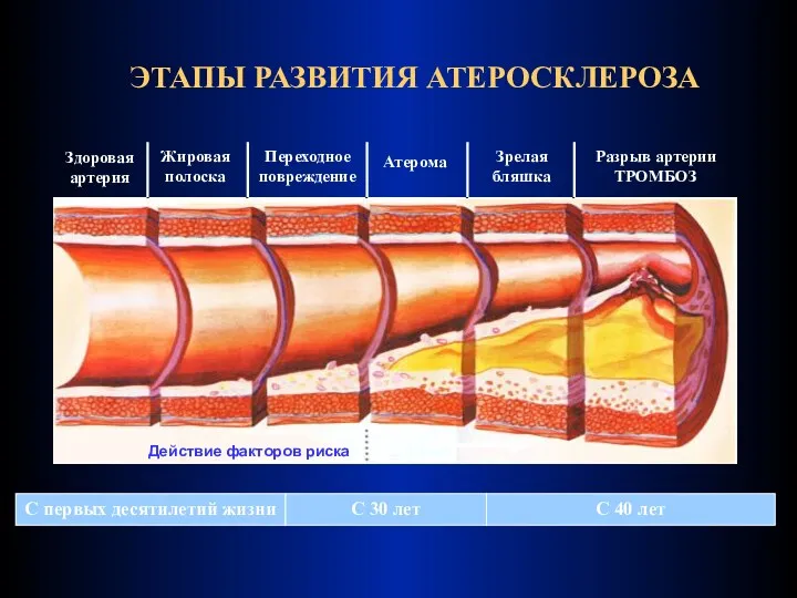 ЭТАПЫ РАЗВИТИЯ АТЕРОСКЛЕРОЗА Здоровая артерия Жировая полоска Переходное повреждение Атерома