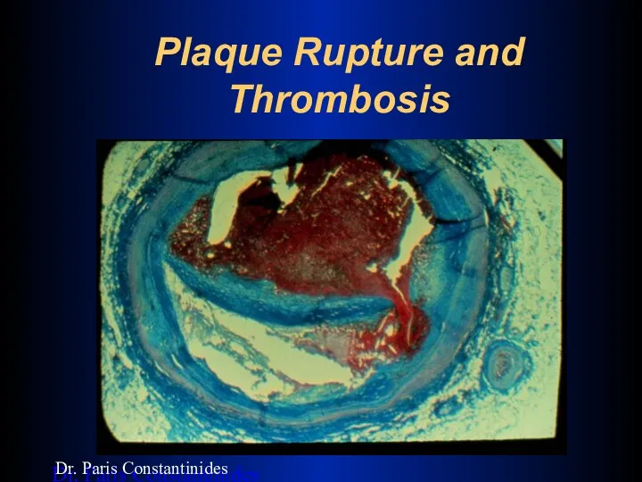 Plaque Rupture and Thrombosis Dr. Paris Constantinides Dr. Paris Constantinides