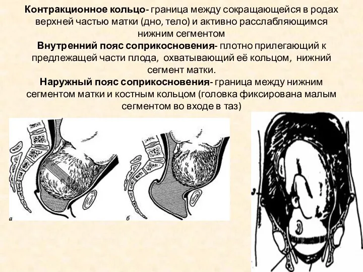 Контракционное кольцо- граница между сокращающейся в родах верхней частью матки