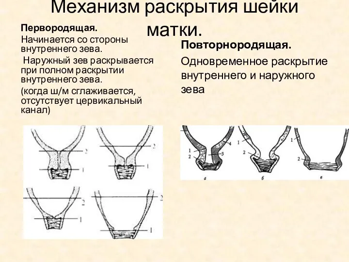 Механизм раскрытия шейки матки. Первородящая. Начинается со стороны внутреннего зева.
