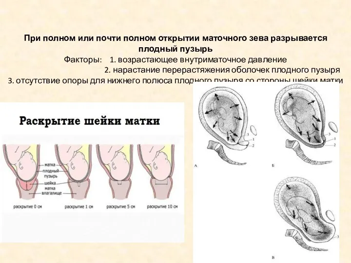 При полном или почти полном открытии маточного зева разрывается плодный