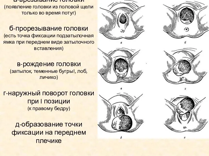 а-врезывание головки (появление головки из половой щели только во время