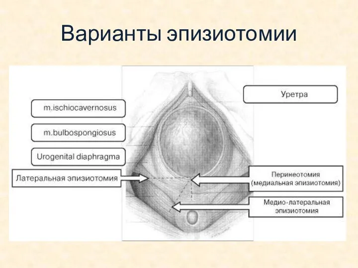 Варианты эпизиотомии