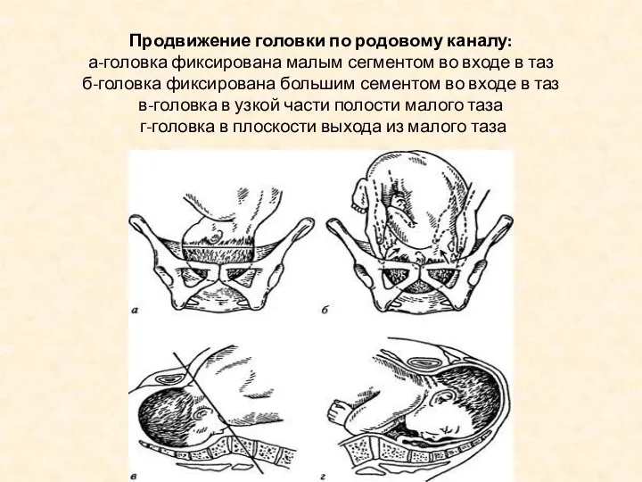 Продвижение головки по родовому каналу: а-головка фиксирована малым сегментом во