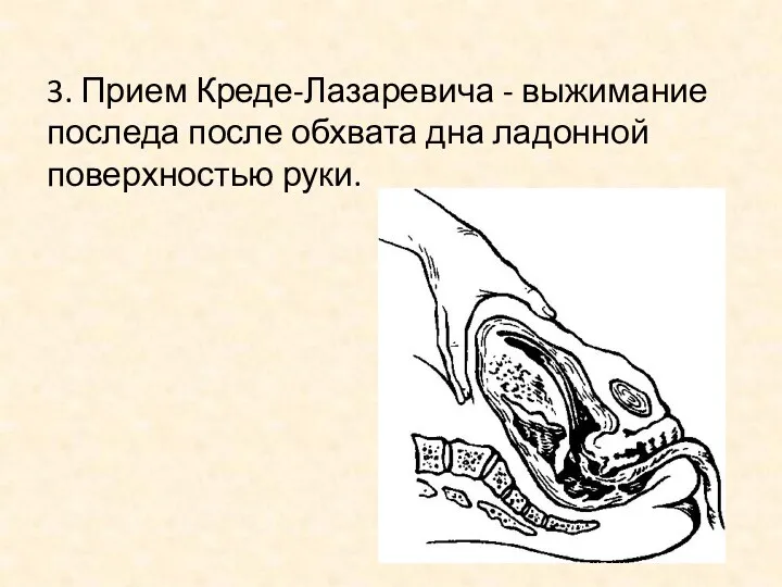 3. Прием Креде-Лазаревича - выжимание последа после обхвата дна ладонной поверхностью руки.