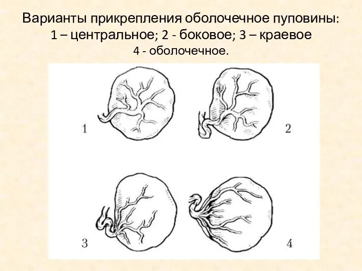 Варианты прикрепления оболочечное пуповины: 1 – центральное; 2 - боковое; 3 – краевое 4 - оболочечное.