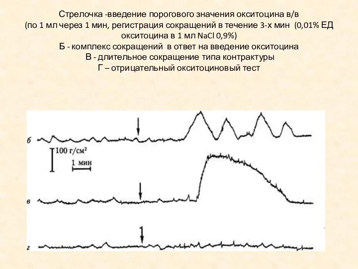 Стрелочка -введение порогового значения окситоцина в/в (по 1 мл через