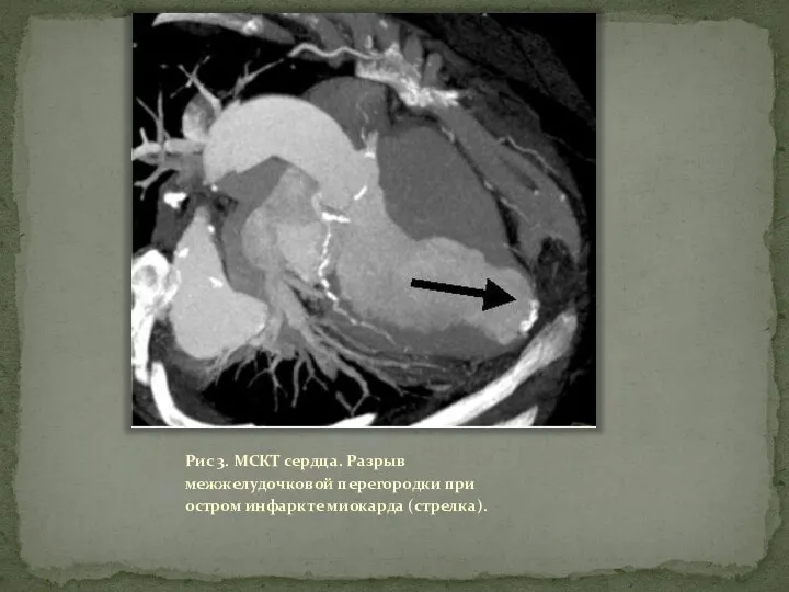 Рис 3. МСКТ сердца. Разрыв межжелудочковой перегородки при остром инфаркте миокарда (стрелка).
