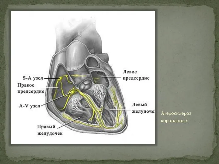 Атеросклероз коронарных