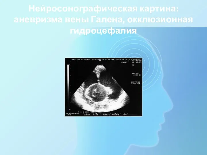 Нейросонографическая картина: аневризма вены Галена, окклюзионная гидроцефалия