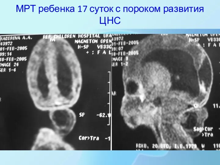 МРТ ребенка 17 суток с пороком развития ЦНС