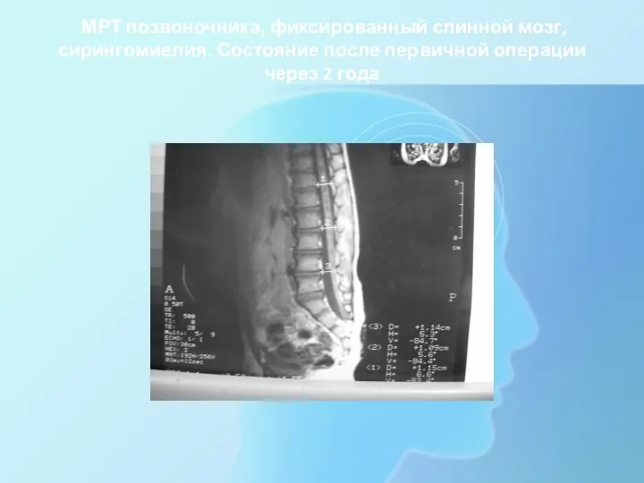 МРТ позвоночника, фиксированный спинной мозг, сирингомиелия. Состояние после первичной операции через 2 года