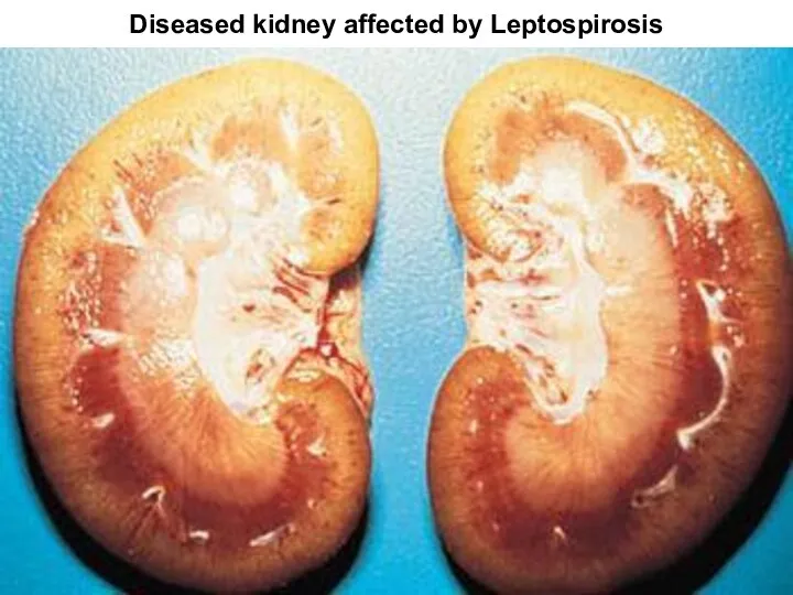 Diseased kidney affected by Leptospirosis