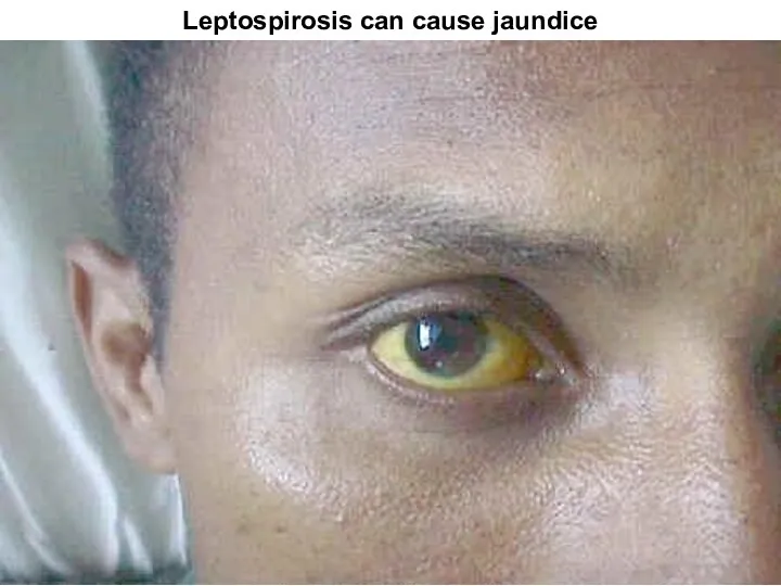 Leptospirosis can cause jaundice