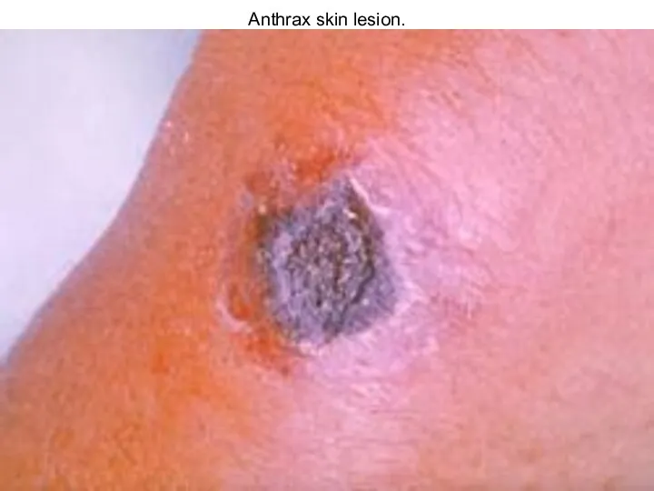 Anthrax skin lesion.