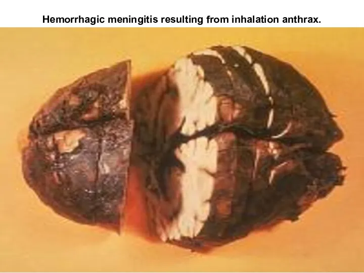 Hemorrhagic meningitis resulting from inhalation anthrax.