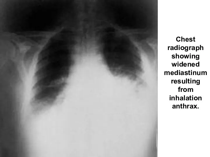 Chest radiograph showing widened mediastinum resulting from inhalation anthrax.