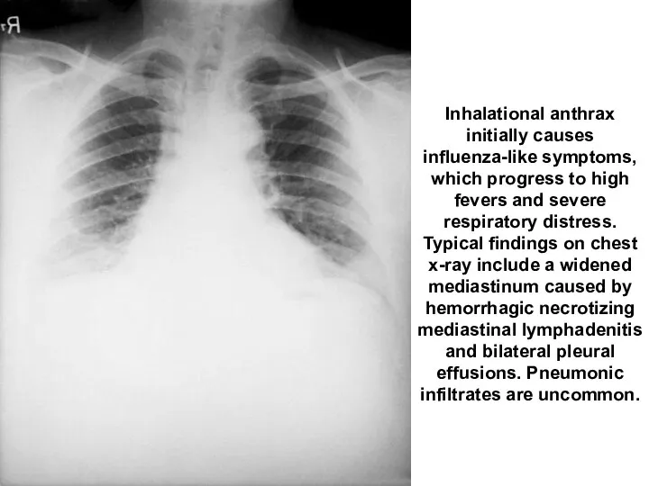 Inhalational anthrax initially causes influenza-like symptoms, which progress to high fevers and severe