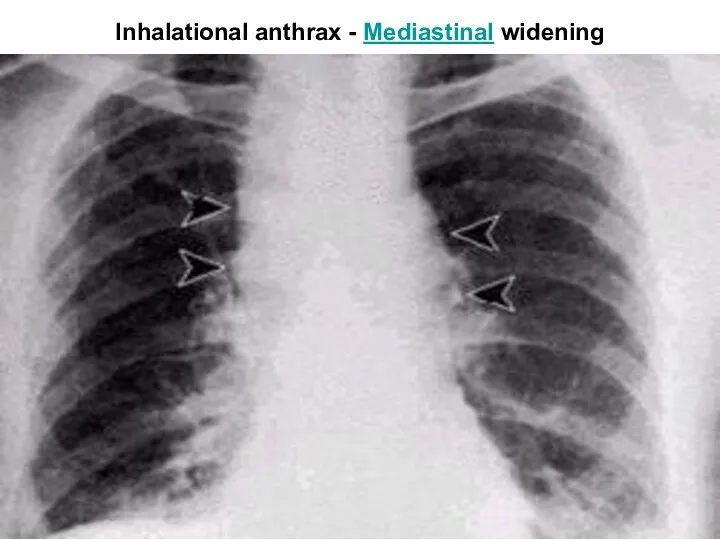 Inhalational anthrax - Mediastinal widening